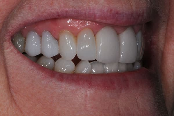 teeth smile enhancement